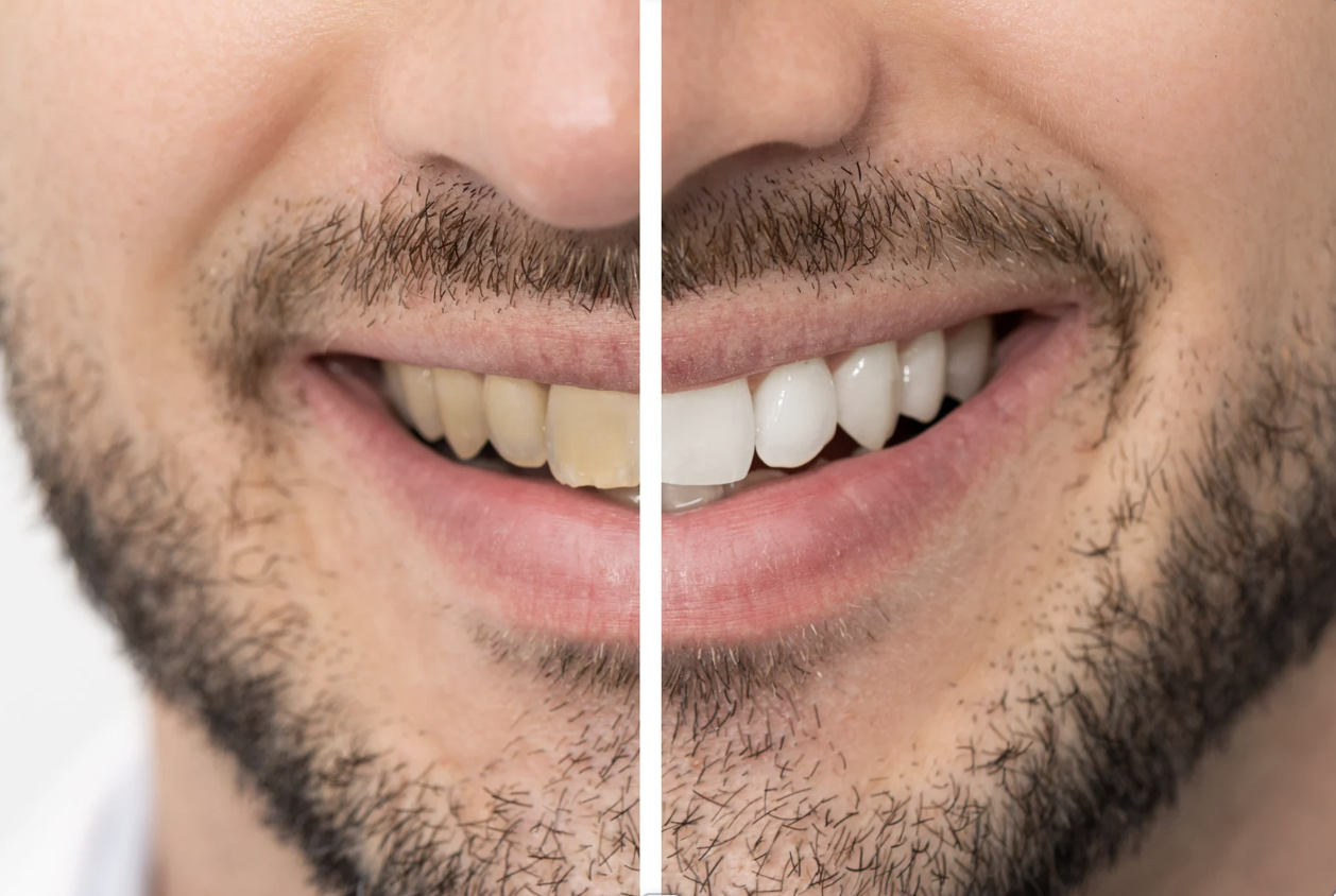 #TeethWhiteningPhoenix #PorcelainTeethWhitening #PhoenixSalon #SmileMakeoverAZ #AdvancedTeethWhitening #HydrogenPeroxideWhitening #PhoenixBeautySalon #TeethWhiteningNearMe #BrightSmilePhoenix #BeautySalonPhoenix #CosmeticTeethWhitening #SalonServicesPhoenix #TeethWhiteningAZ #LashesAndBodyOnFleek #GlowUpPhoenix #SmileBrightAZ #AffordableTeethWhitening #BestSalonPhoenix #BrighterSmile #SensitiveTeethSafe #WhiterTeethFast #BeautyInPhoenix #EventReadySmile #LocalSalonPhoenix #BodyAndLashPhoenix #SalonGlowUp #SelfCarePhoenix #ToothWhiteningSalon #NonInvasiveWhitening #PhoenixBeautyExpert